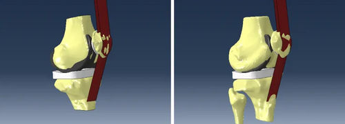 Logiciel d'analyse - Abaqus Knee Simulator - SIMULIA - de simulation / de modélisation / de conception